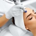 Microneedling Treatment